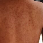 getty-images-sarampion-185855